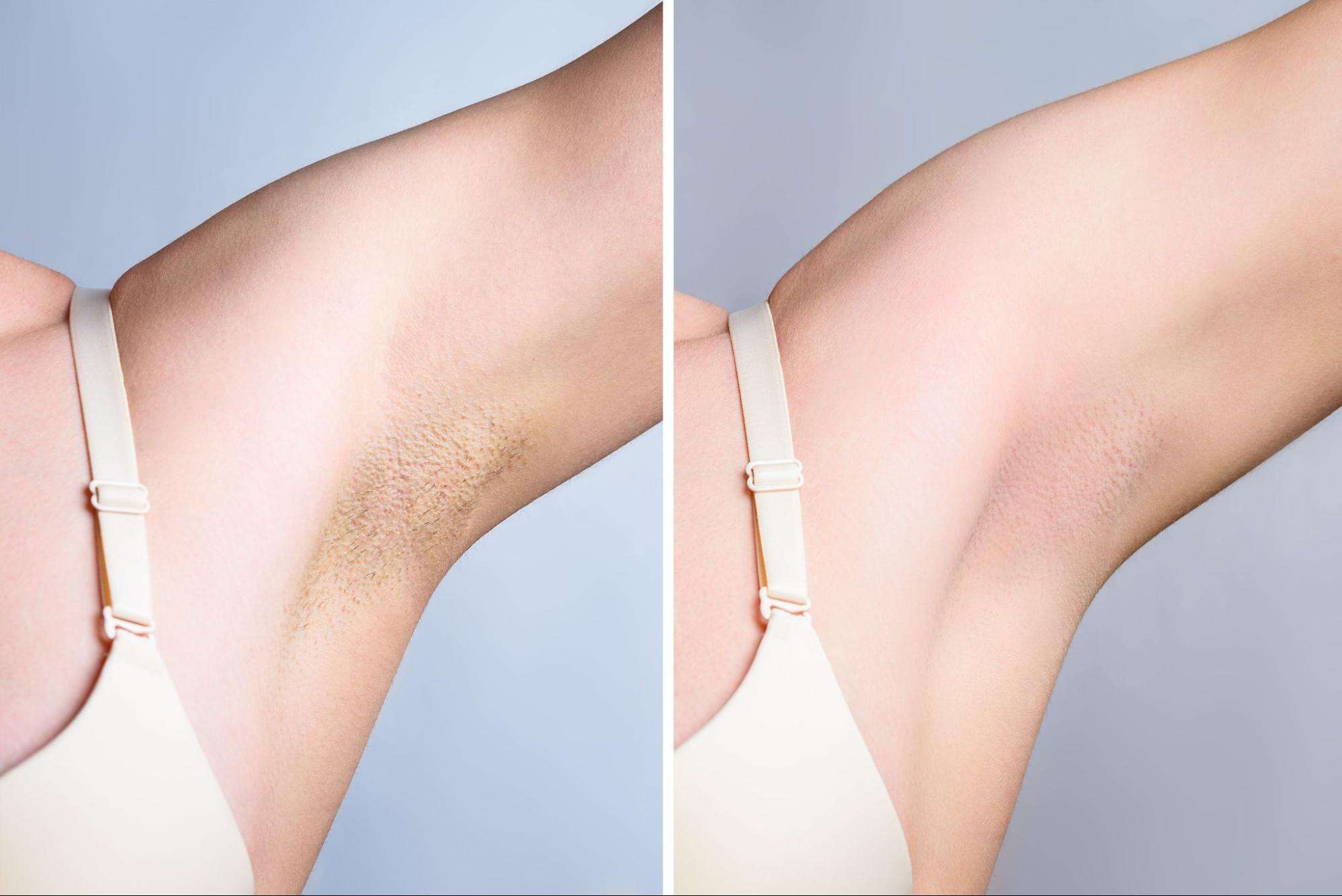 Close-up of smooth skin after DiolazeXL laser hair removal treatment.