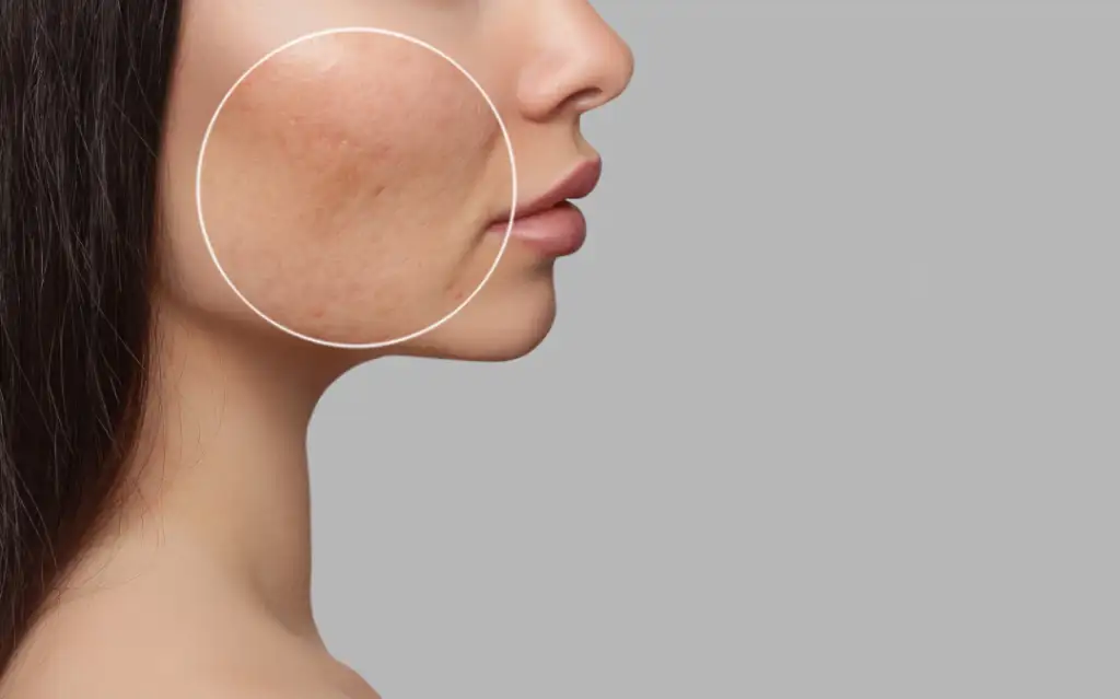 Close-up of acne scars highlighting potential treatment with wrinkle relaxers.