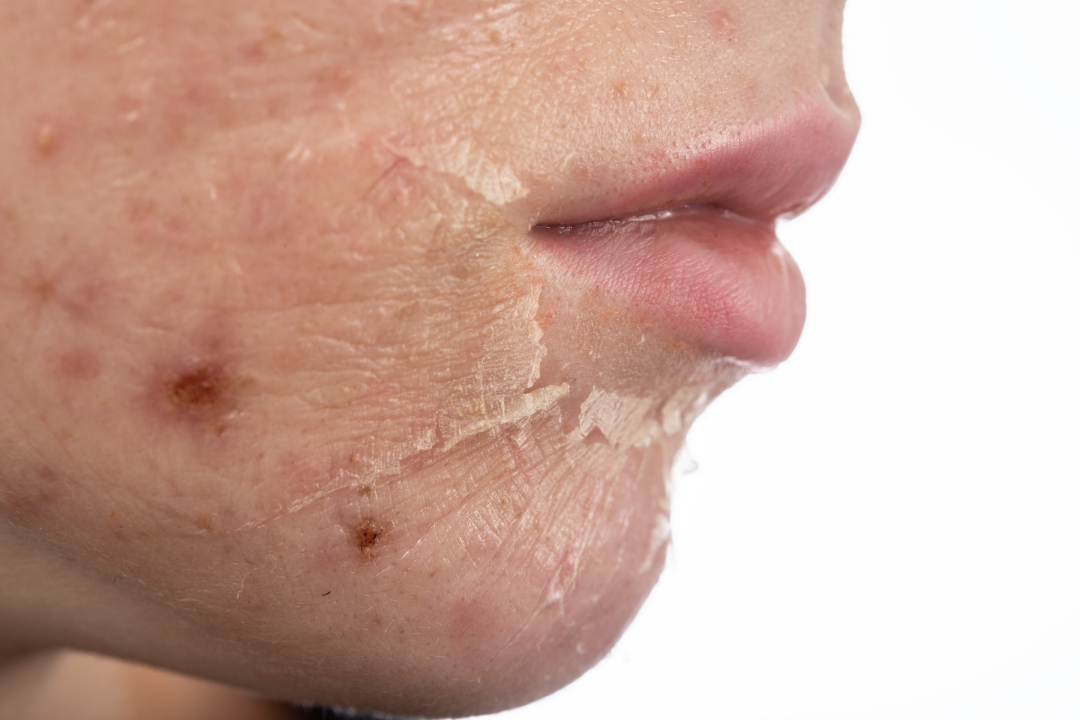 A close-up of skin undergoing exfoliation and peeling as part of an acne treatment process.