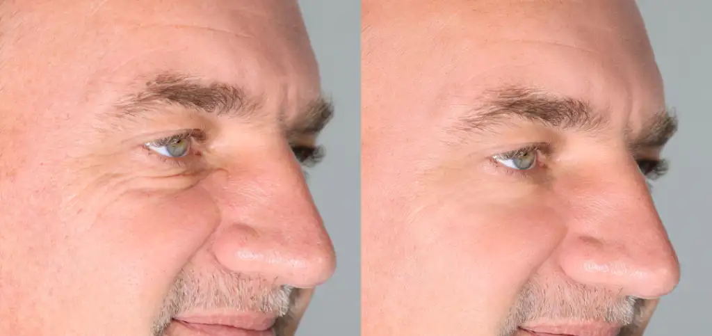 A before-and-after comparison of a man’s skin, highlighting the visible effects of a facial for men.