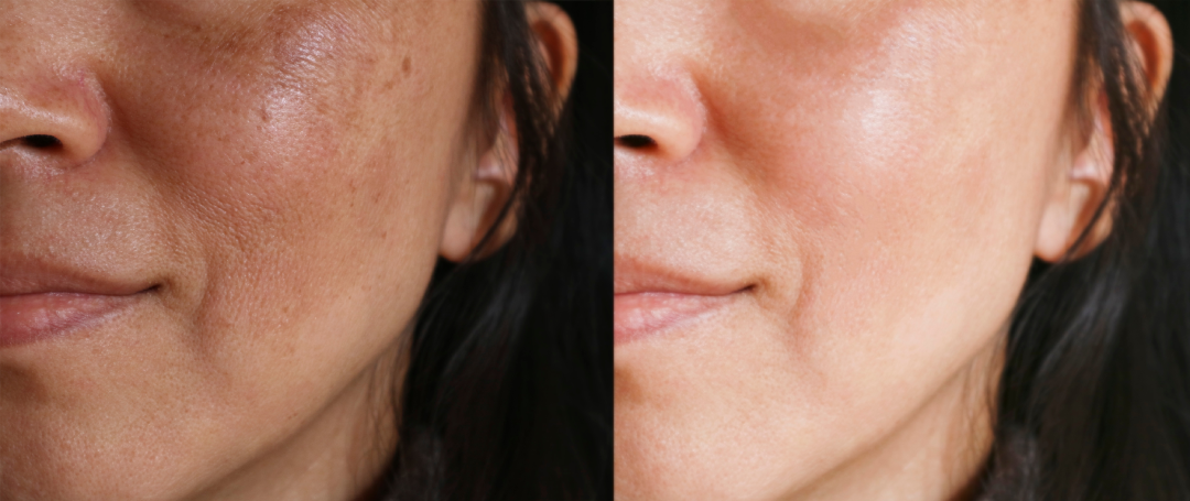 A close-up before-and-after comparison showing the effects of skin resurfacing on melasma pigmentation.